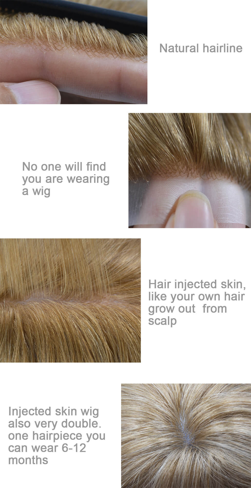 injected thin skin hair system