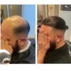 thin skin hairpiece