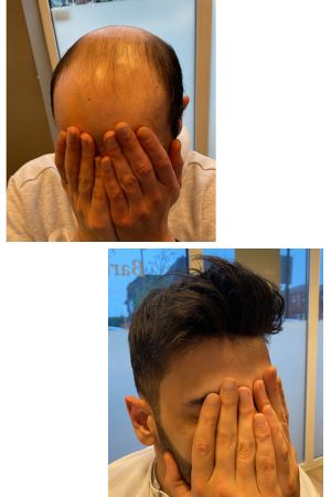 hair piece for men