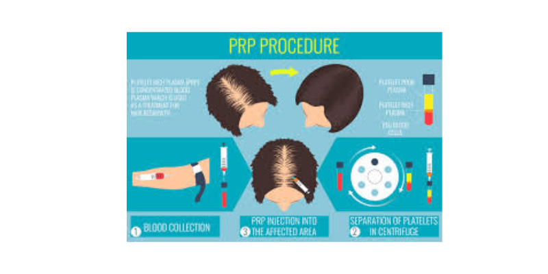 Platelet-Rich Plasma (PRP) Therapy