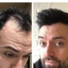 Best men's hairpiece men's frontal hair piece