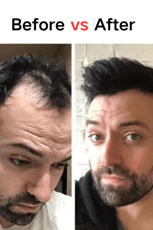 Best men's hairpiece men's frontal hair piece