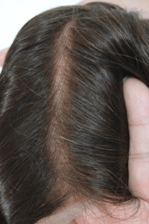 french lace hair replacement system