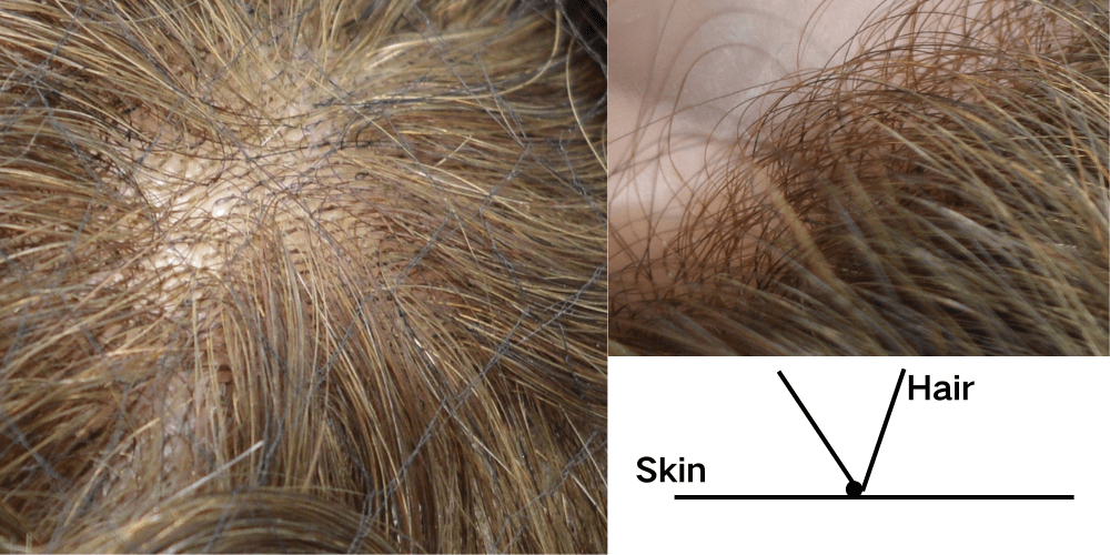 Front v-loop thin skin hair system hairpiece for men