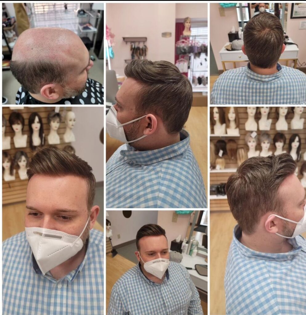 hair replacement kansas city