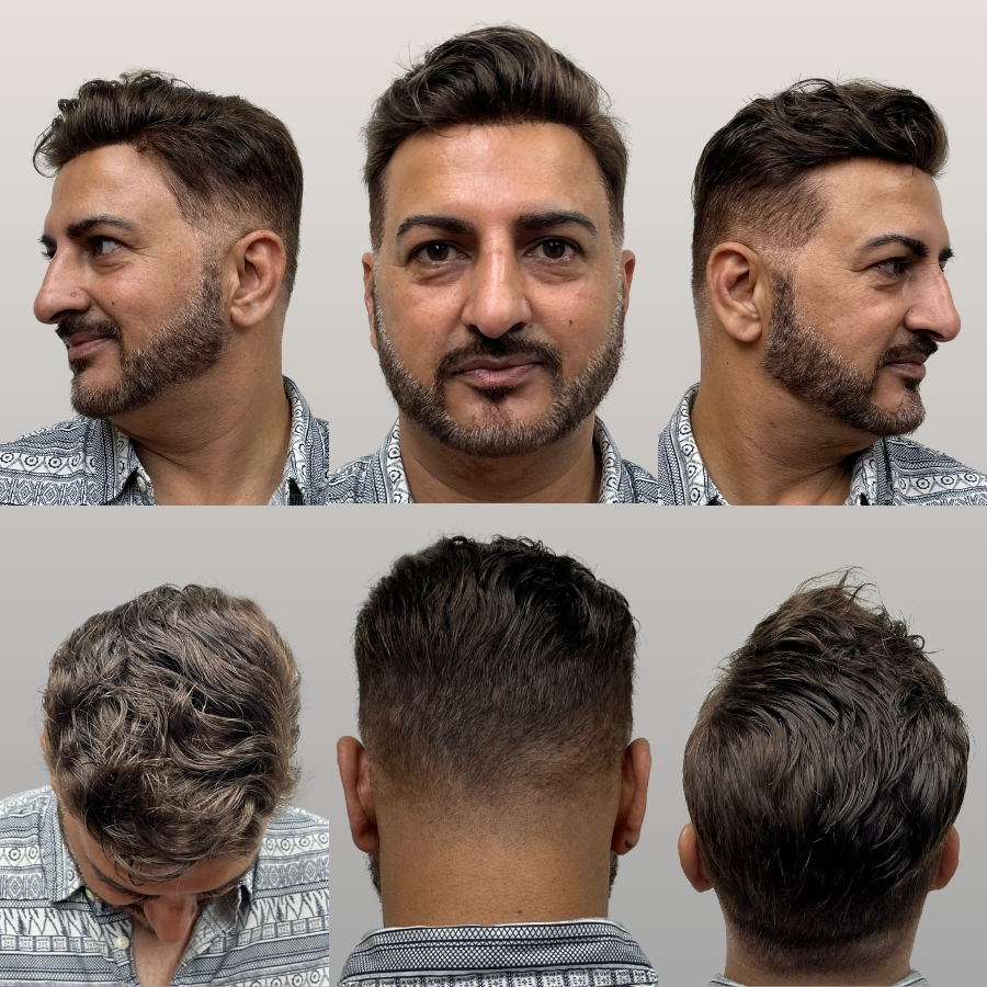 hair replacement raleigh