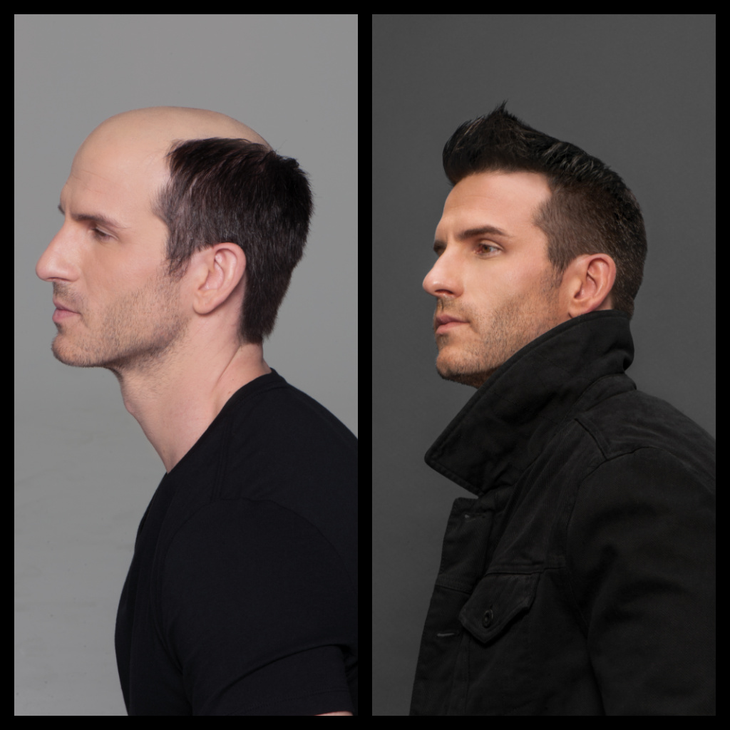 hair replacement nj