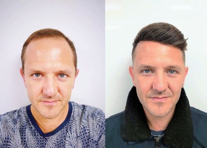 bad toupees