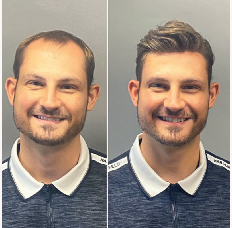 hair replacement nashville tn HairNotion