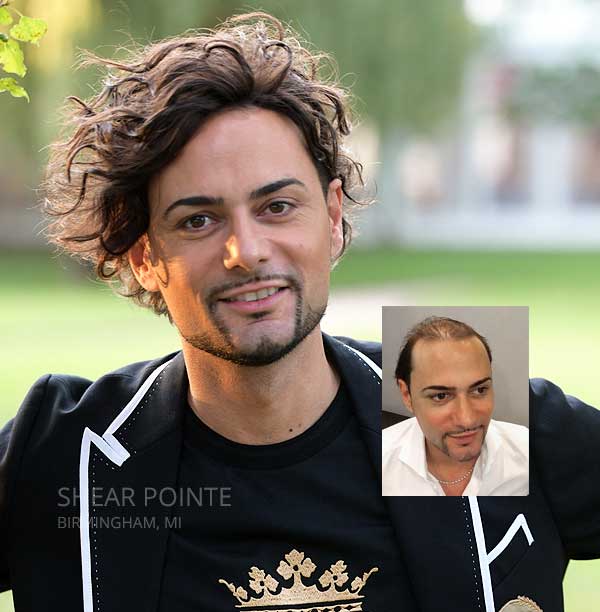 hair replacement detroit