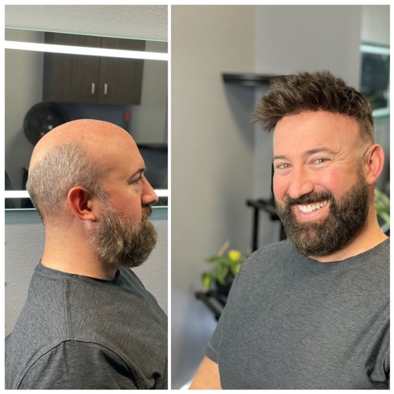orange county hair replacement HairNotion