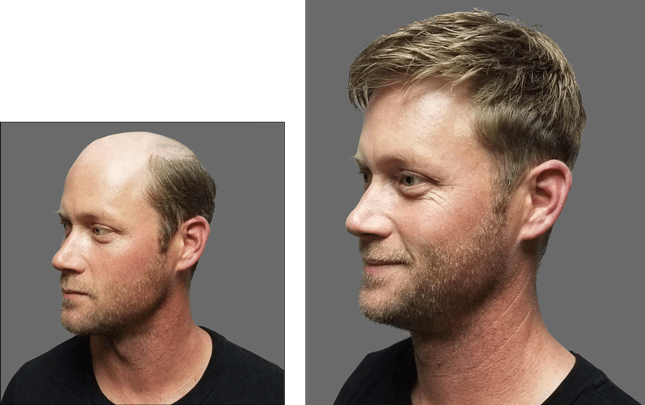 orange county hair replacement