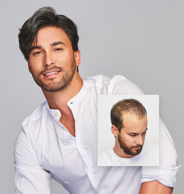 orange county hair replacement
