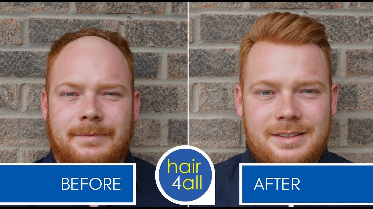 orange county hair replacement