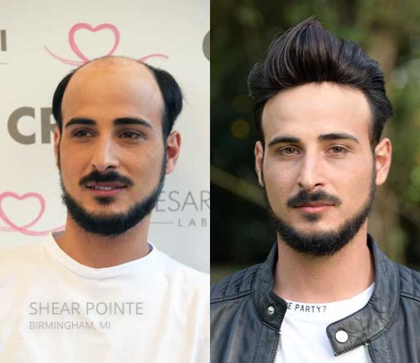 hair replacement michigan