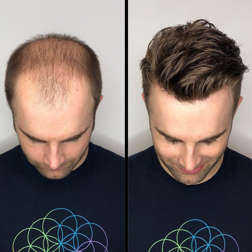 hair replacement in florida