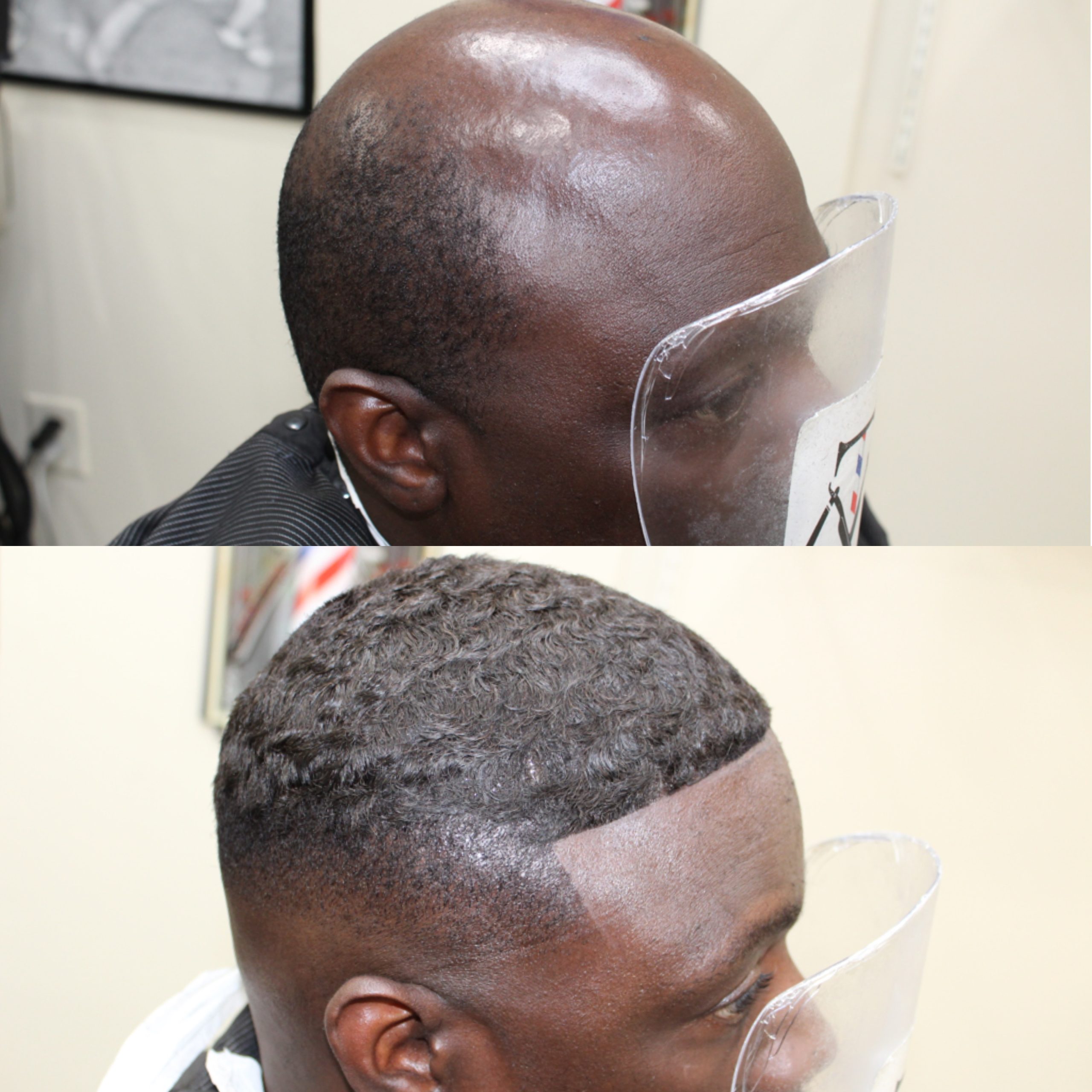 hair replacement cleveland