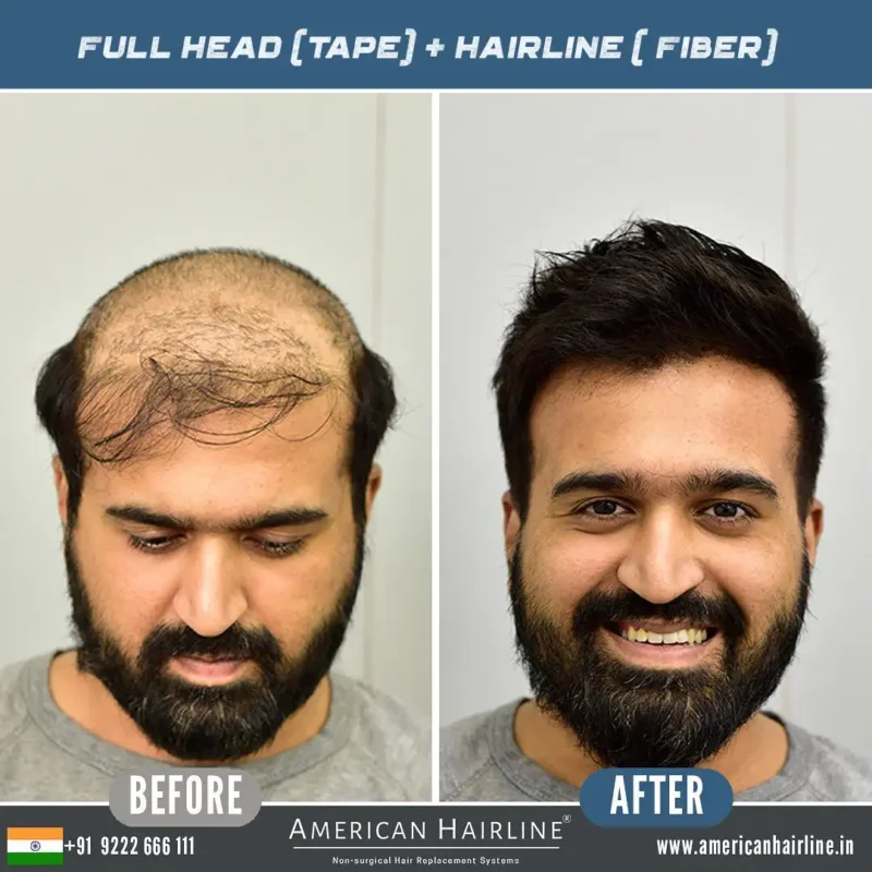 hair replacement in hyderabad HairNotion