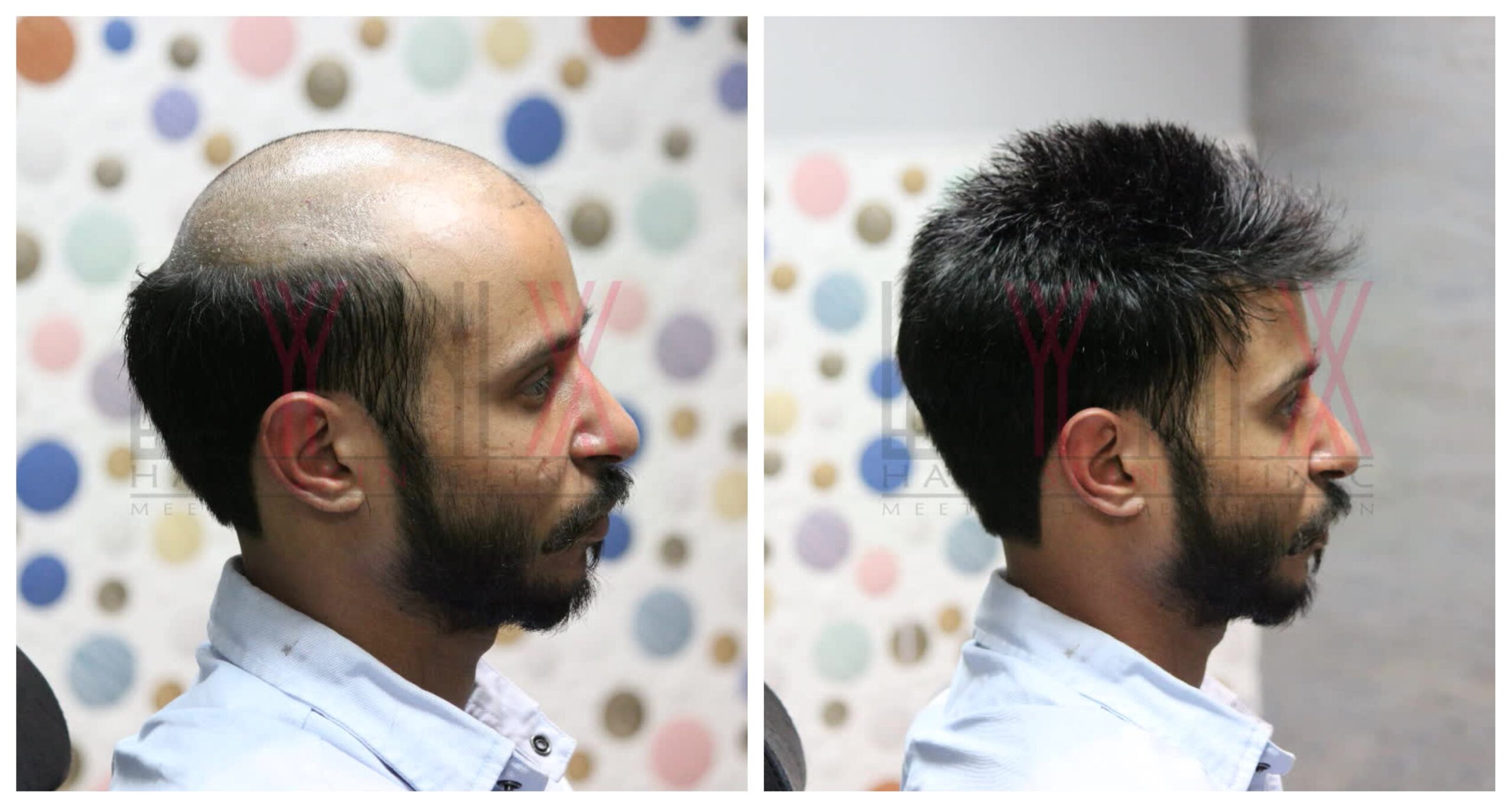 hair replacement in hyderabad