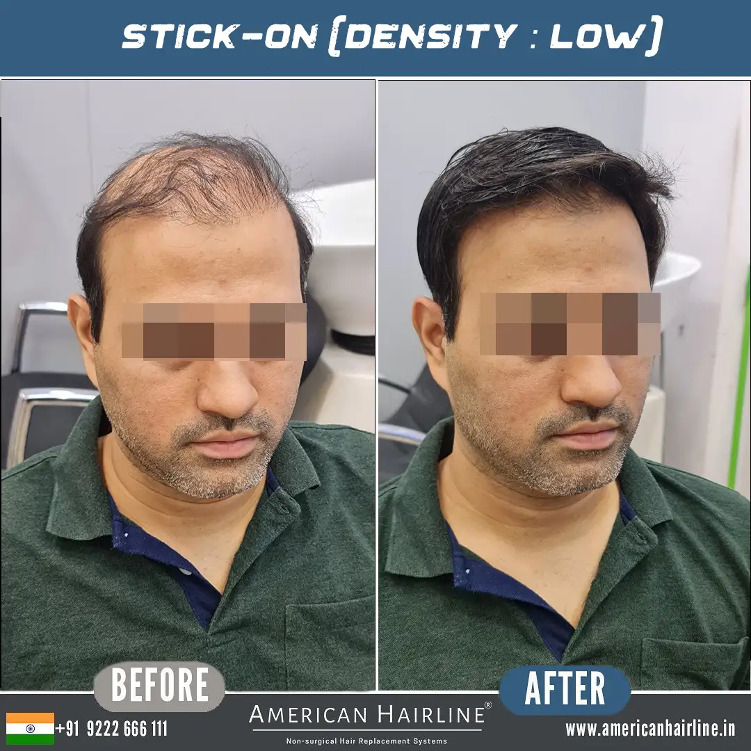 hair replacement in hyderabad
