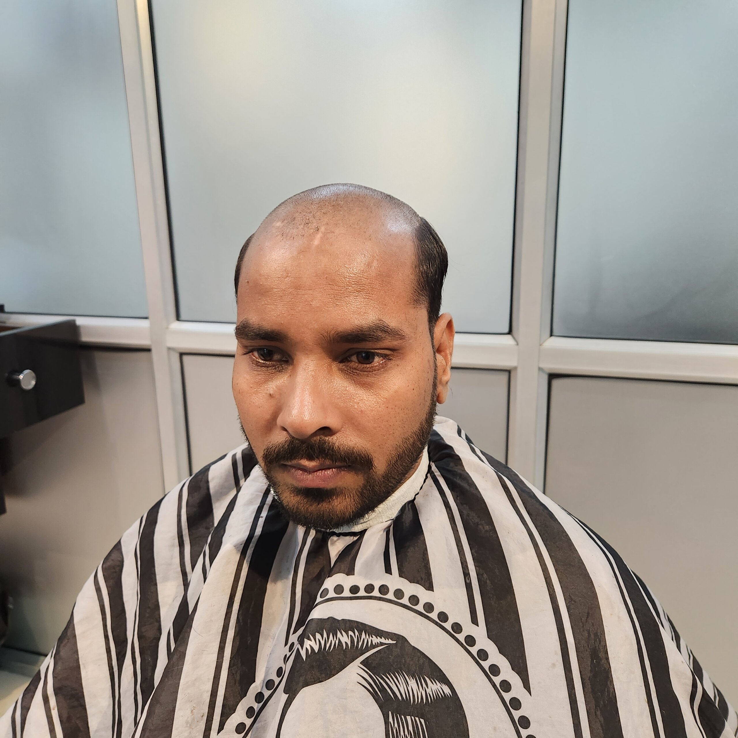 hair replacement in hyderabad