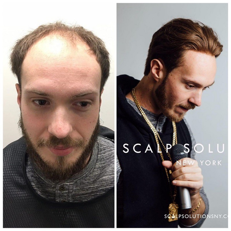 lavivid hair system