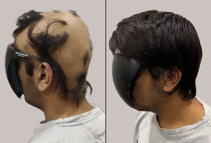 wigs for chemotherapy patients HairNotion