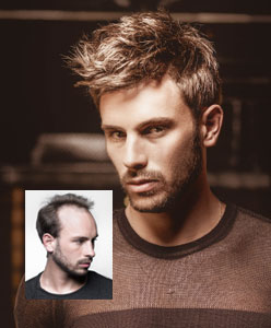 hair replacement boston ma
