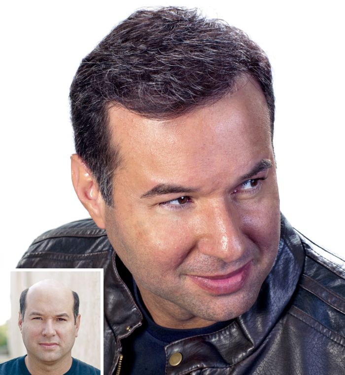 hair replacement boston ma