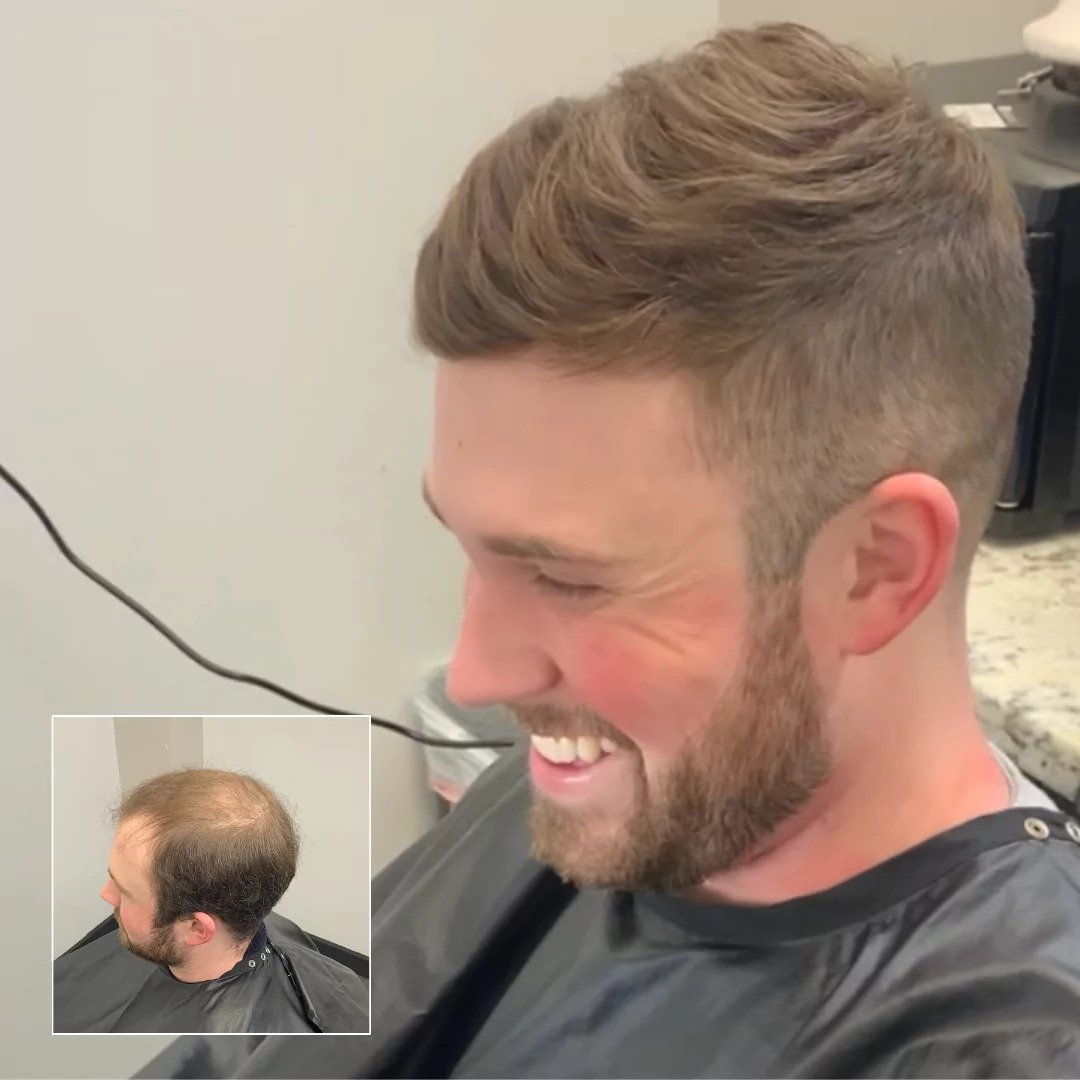hair replacement charlotte nc