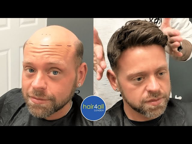 hair replacement in pittsburgh