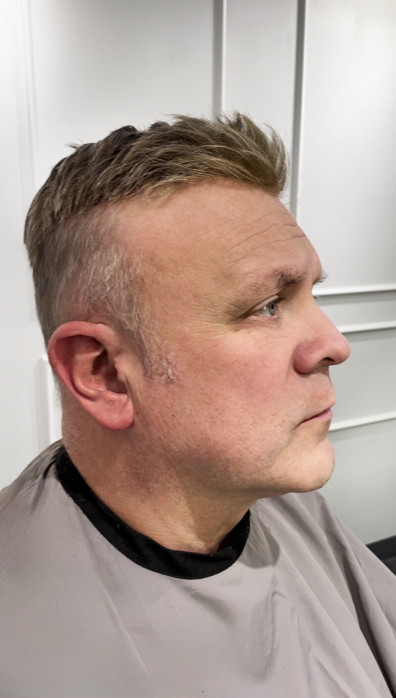 hair replacement cleveland ohio