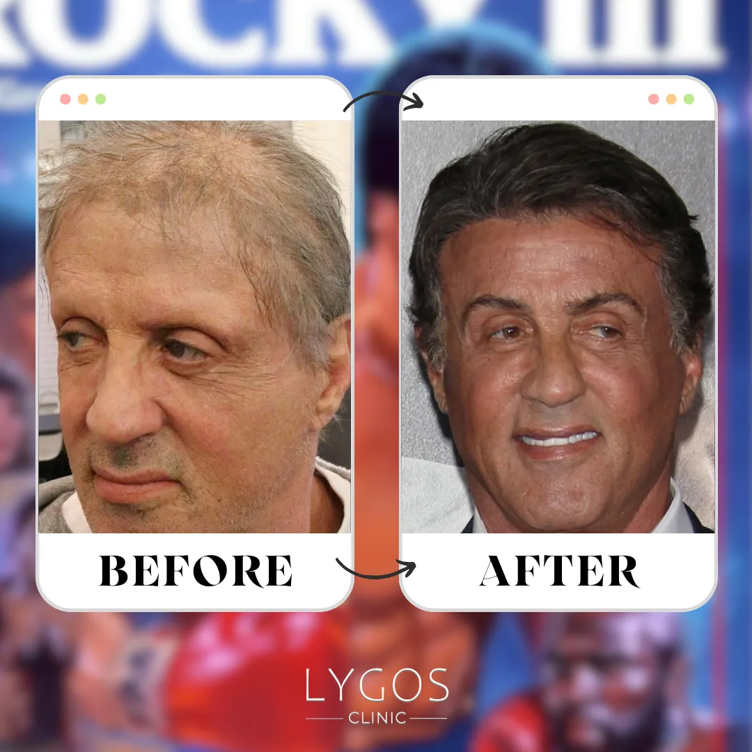 sylvester stallone toupee