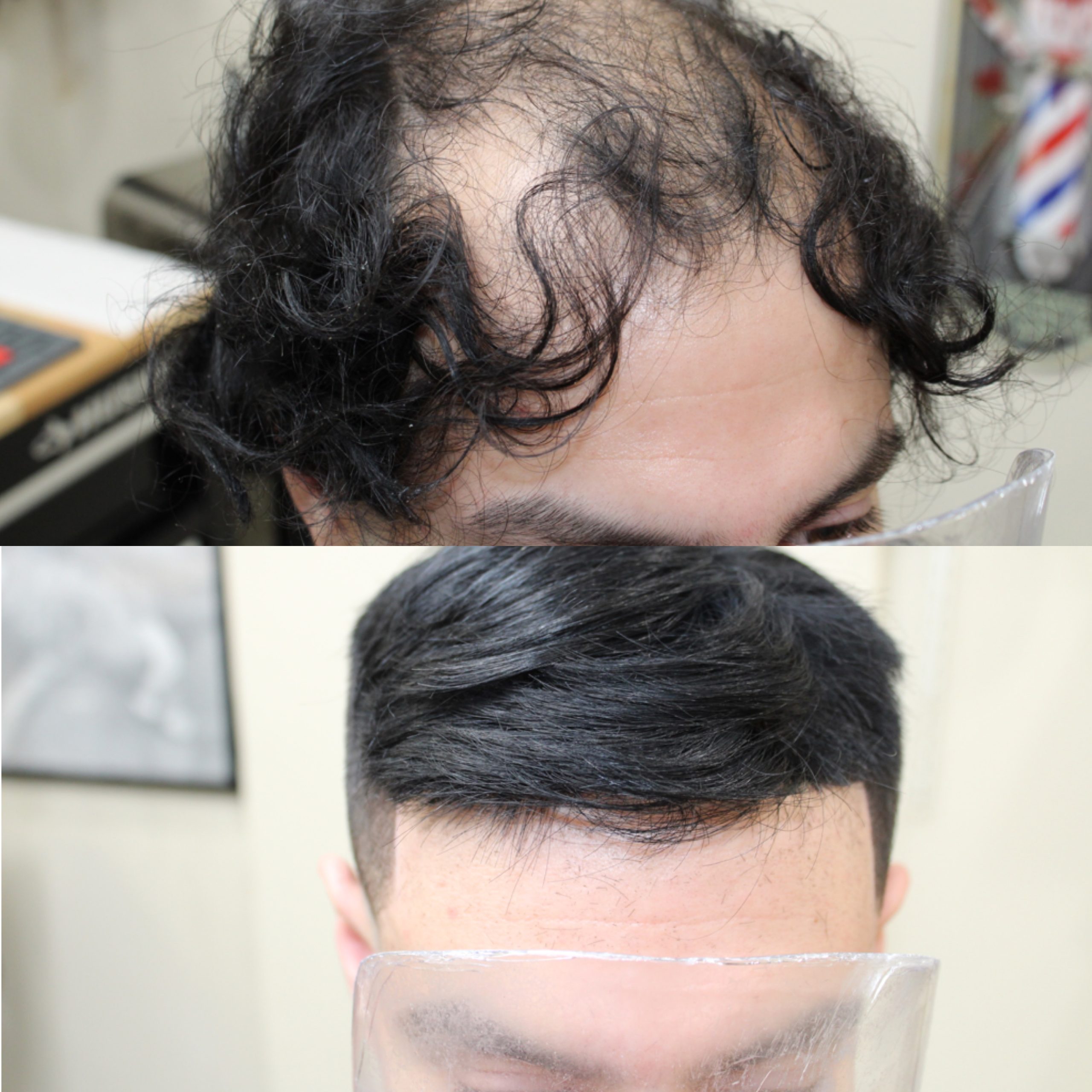 hair replacement cincinnati ohio