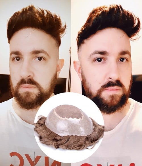hair replacement austin texas