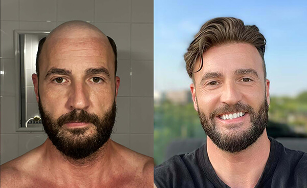 toupee before and after