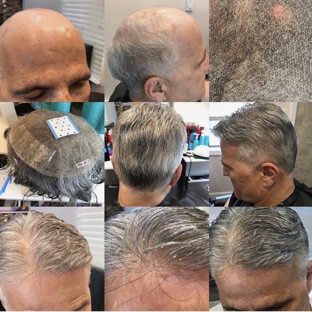 hair replacement in new york