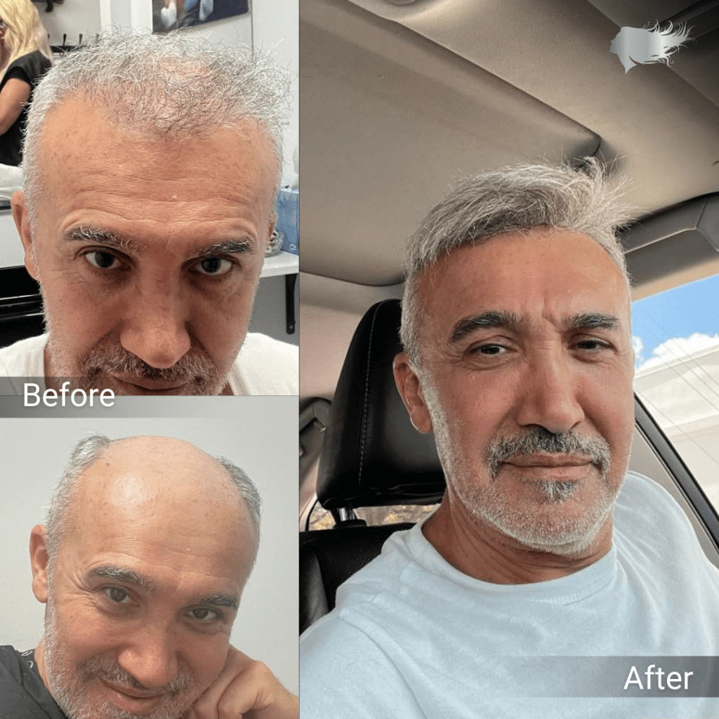 hair replacement boca raton
