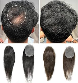 hair patches for bald spots