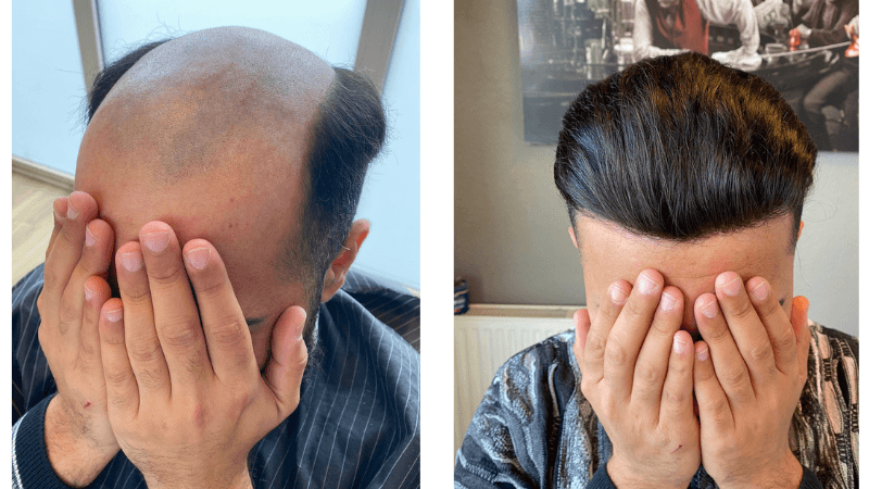 wear hairnotion hiar system before and after(2)